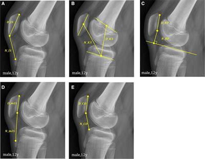 Evaluation of age group and sex differences in the measurement of patellar height of pediatric knee in a Korean population